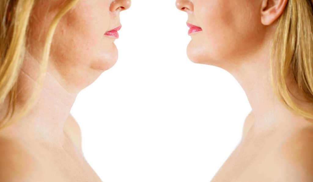 Double Chin treatment Hanwell before and after results