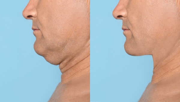 Which Non-Surgical Treatments Work Best for Jowls and Loose Skin Hanwell?
