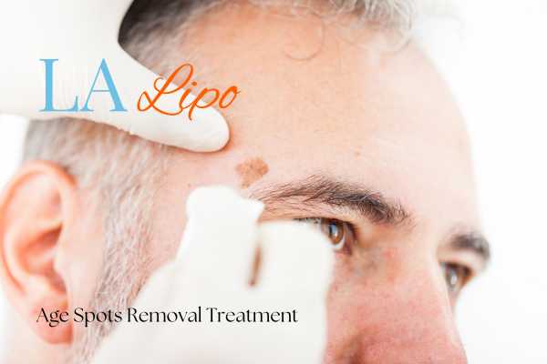 What Are the Most Effective Treatments for Age Spots Hanwell?