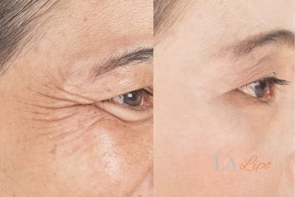 Before and after results of woman - HI-fu wrinkles reduction treatment Hanwell