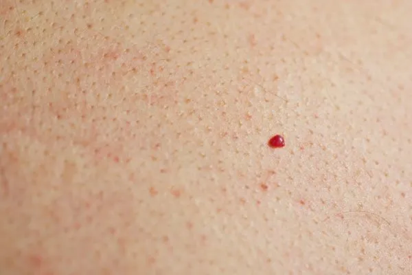close up of a cherry angioma Hanwell