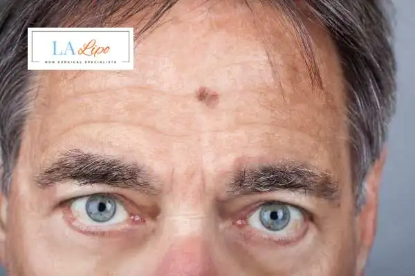 Solar Lentigo Removal Hanwell image of man with mark on his forehead