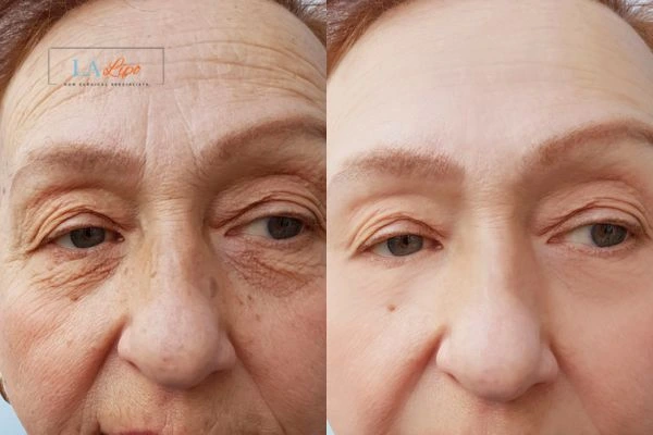 The powerful benefits of Morpheus8 Treatment Hanwell - Call Our team today!