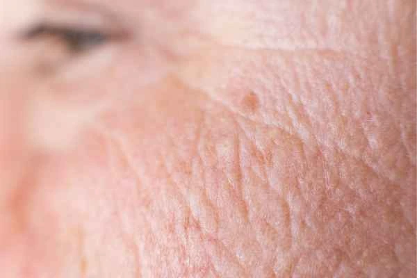 close up picture of a woman's face showing an age spot Hanwell