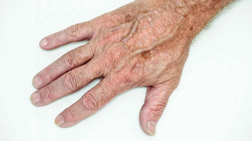 Male hand showing age spot Hanwell