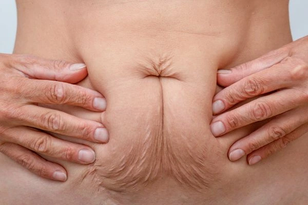 Should I Combine Diastasis Recti Treatment with Body Contouring for Better Results Hanwell?
