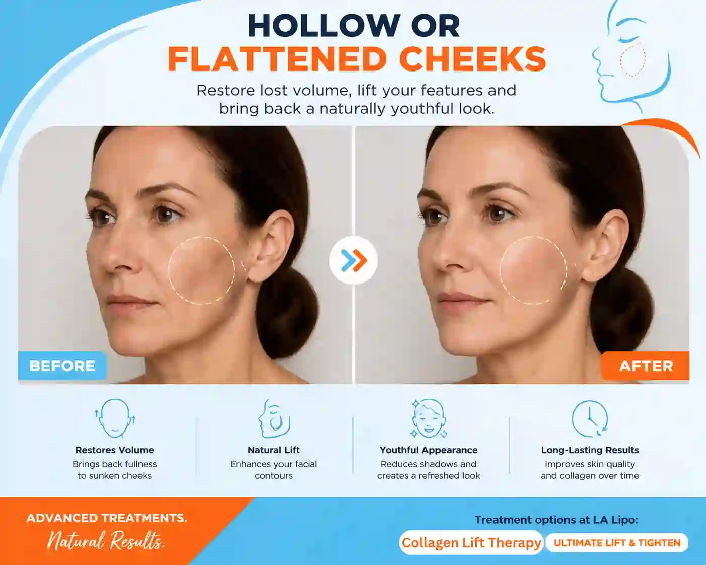 Sign #4: Hollow or Flattened Cheeks Hanwell