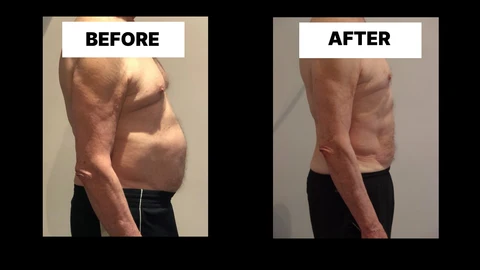 What Symptoms Can Diastasis Recti Cause in Men? Weak Core, Back Pain and Poor Posture Hanwell